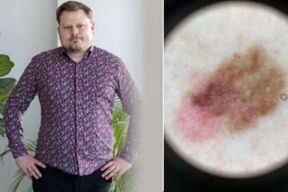 Manzelka si vsimla znamienko hovori Matej Bista